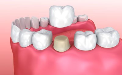 dental-crownsNKS0925