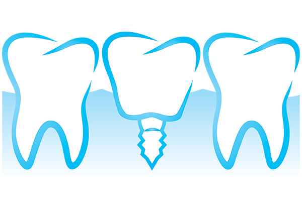 dental-implant