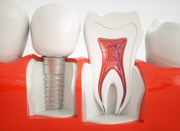 dental-implants-N2008