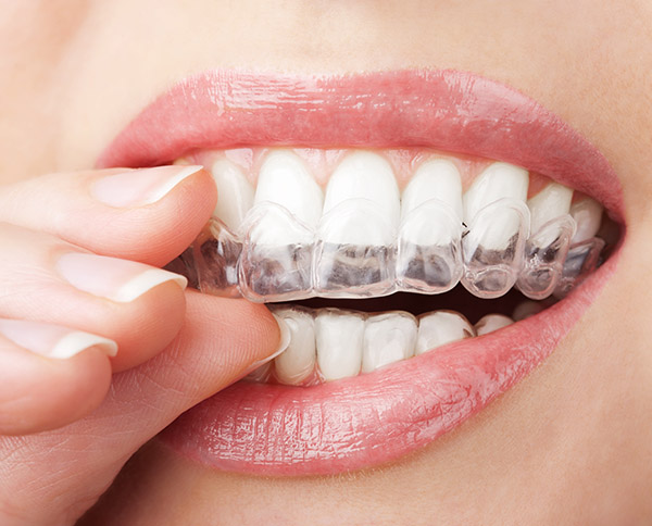 invisalign-1